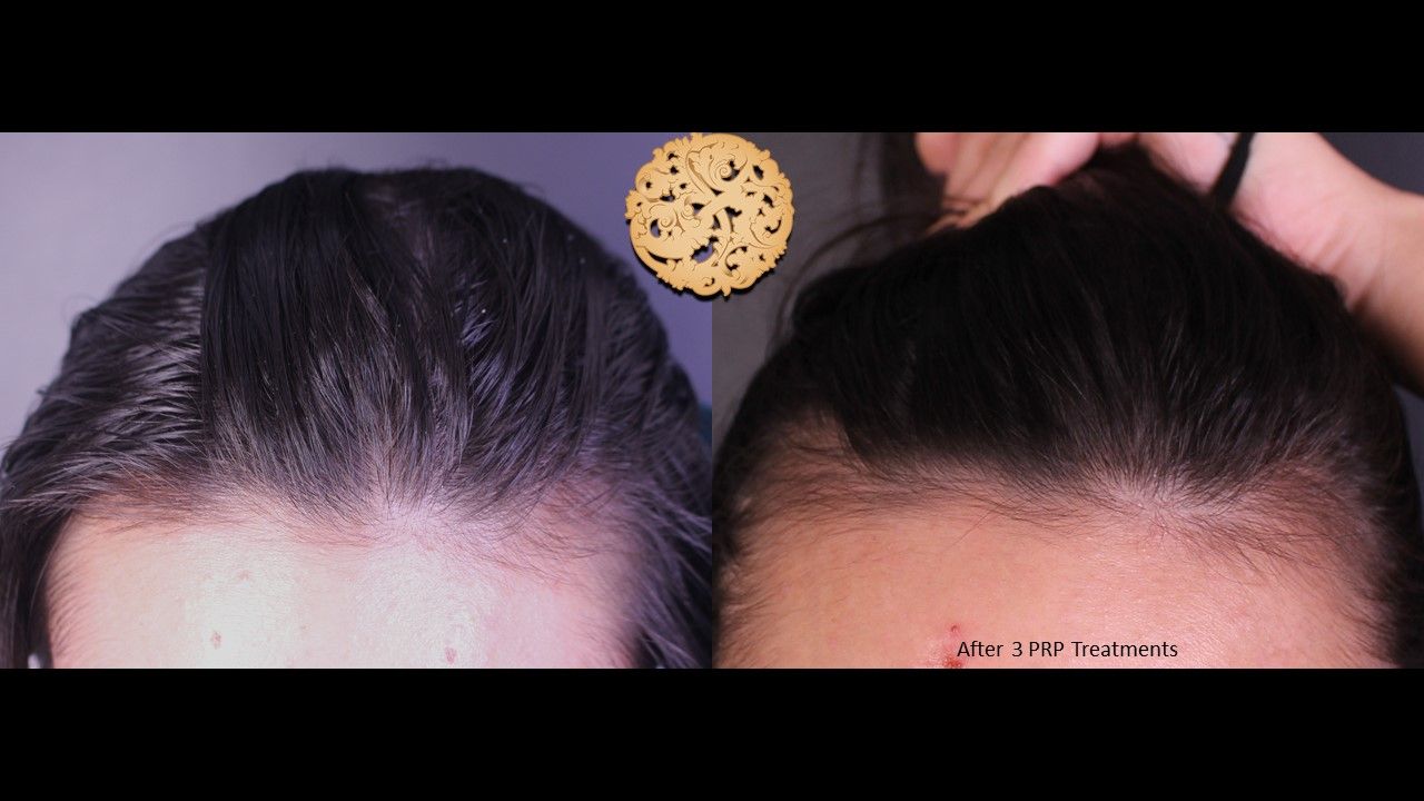 Prp Hair Restoration Before & After