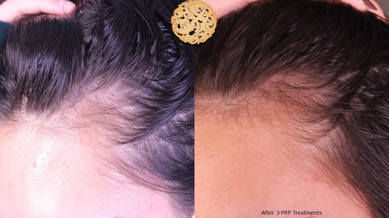 Prp Hair Restoration Before & After
