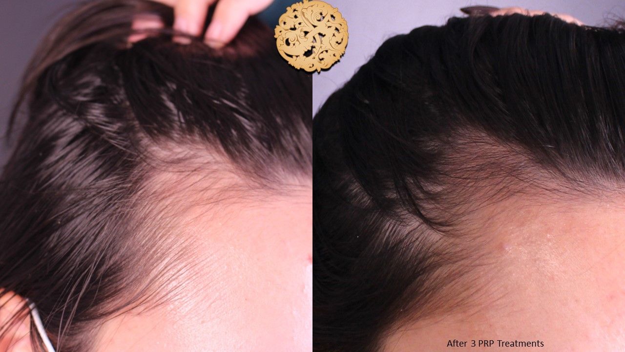 Prp Hair Restoration Before & After