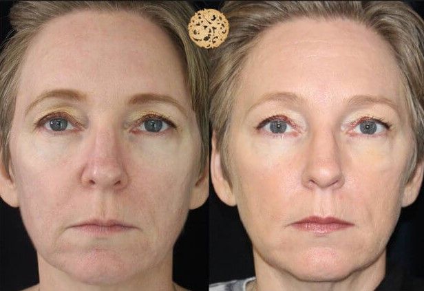 Pdo Threads Before & After