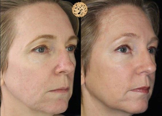 Pdo Threads Before & After