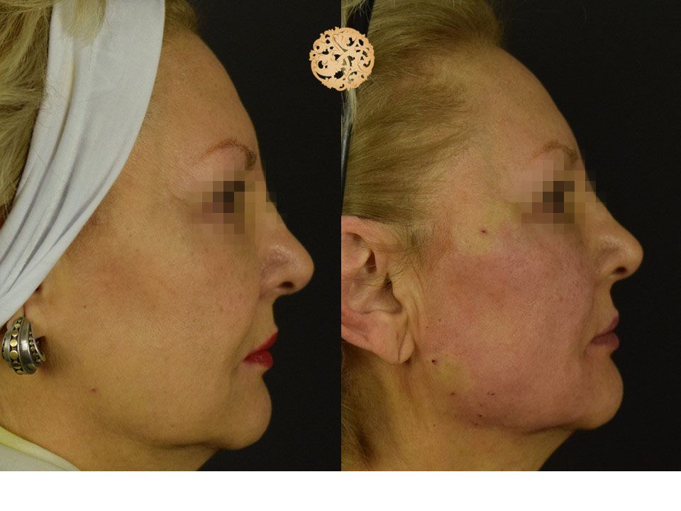 Pdo Threads Before & After