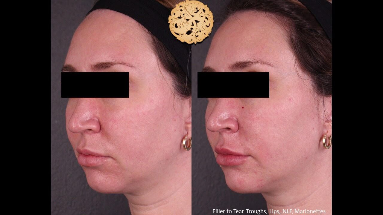 Dermal Filler Before & After