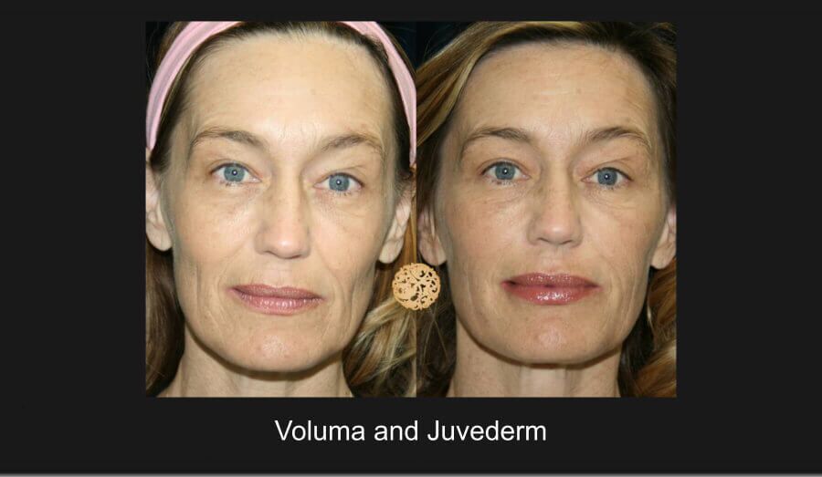 Dermal Filler Before & After
