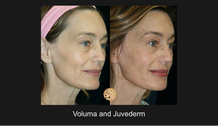 Dermal Filler Before & After