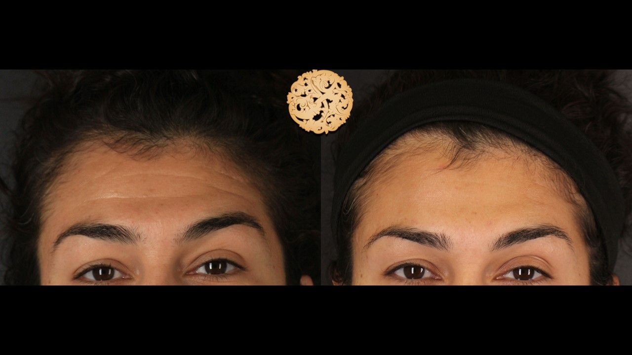 Botox Before & After