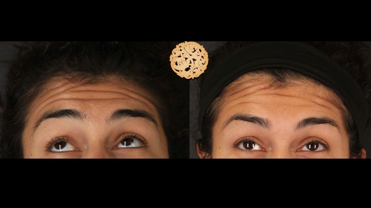 Botox Before & After