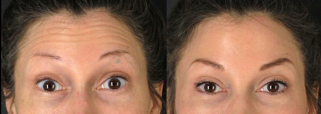 Botox Before & After