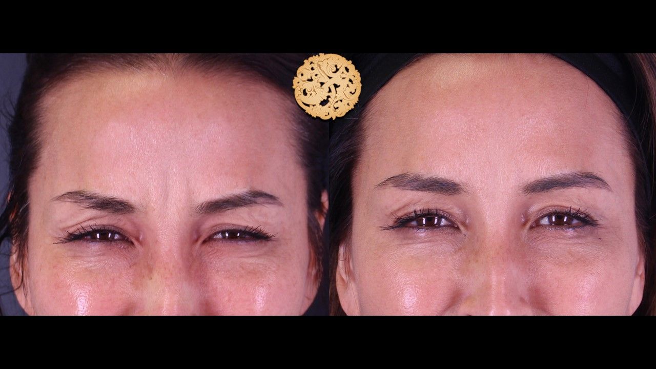 Botox Before & After