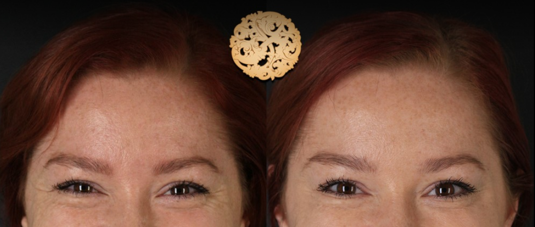 Botox Before & After