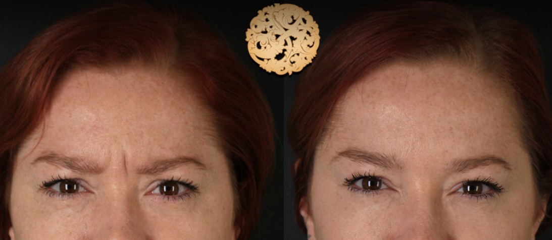 Botox Before & After