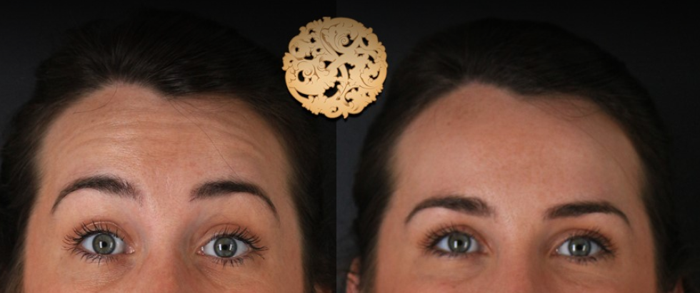 Botox Before & After