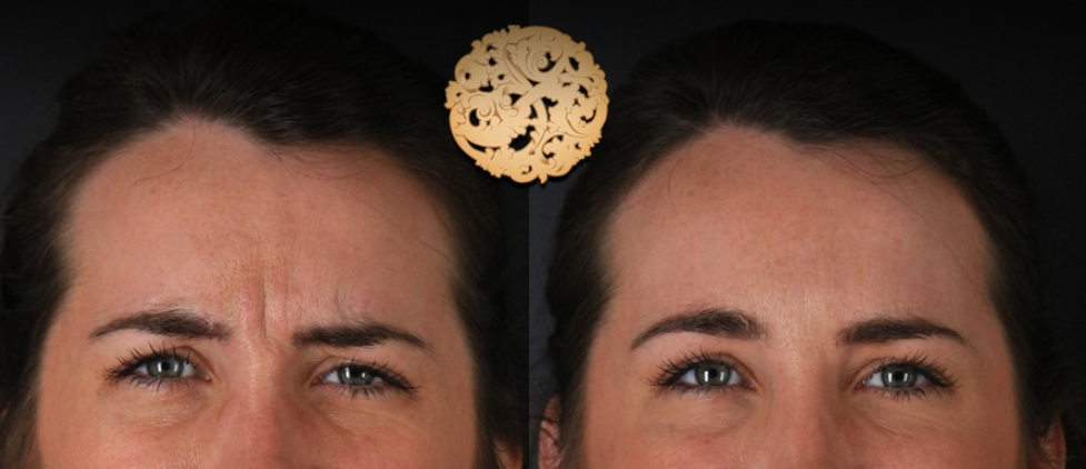 Botox Before & After