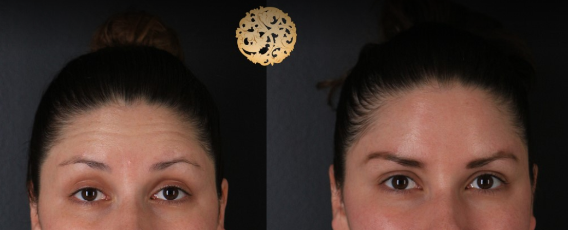 Botox Before & After