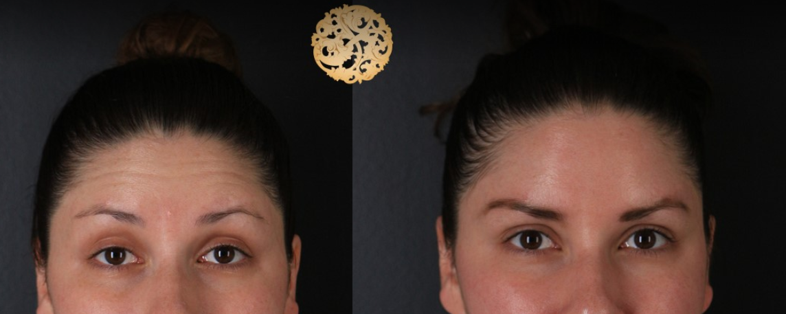 Botox Before & After