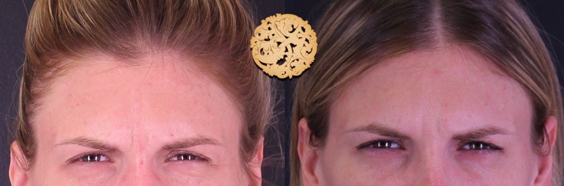 Botox Before & After