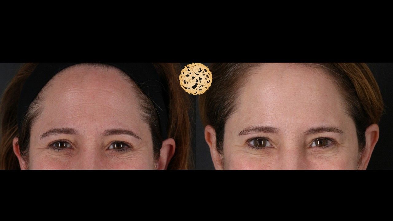 Botox Before & After