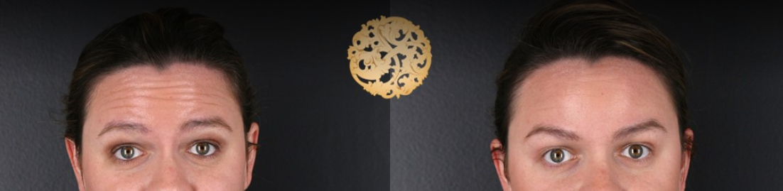 Botox Before & After