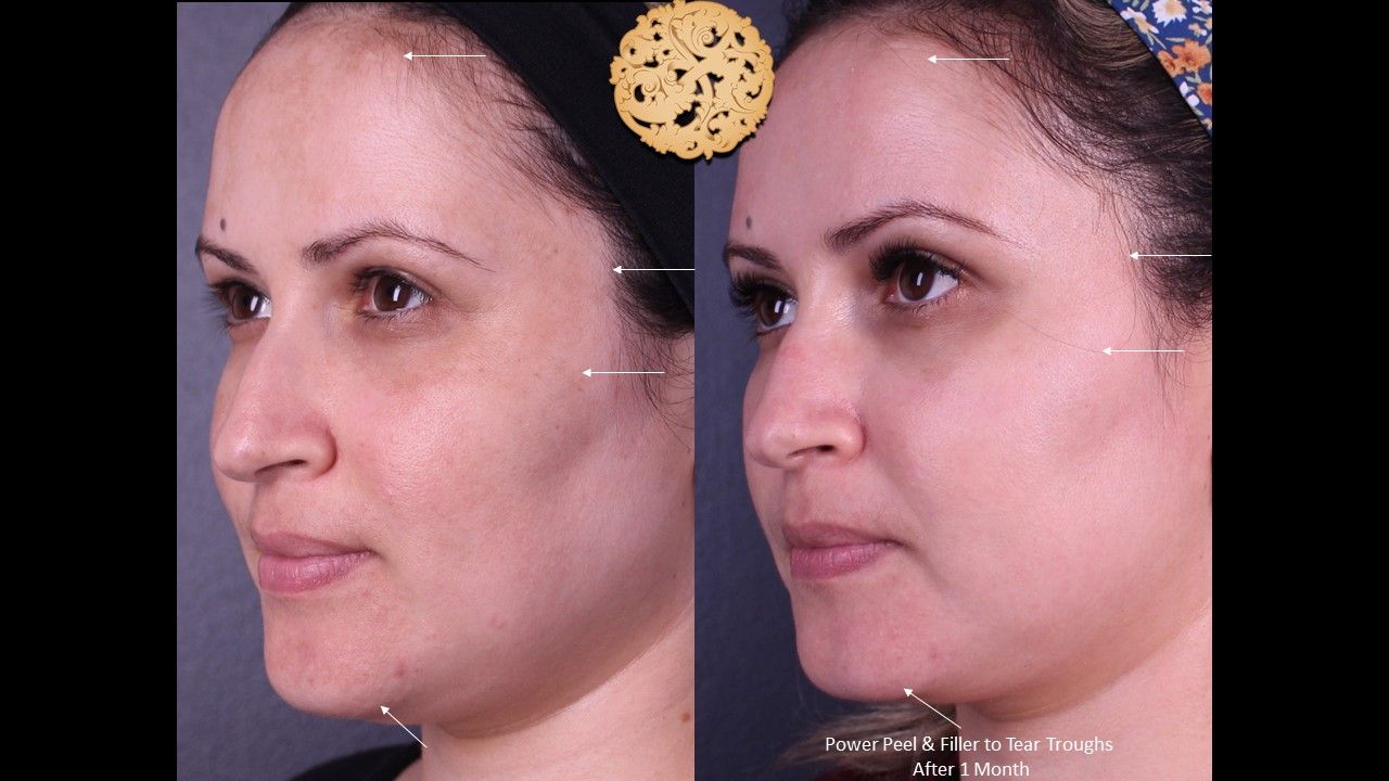 Botox Before & After