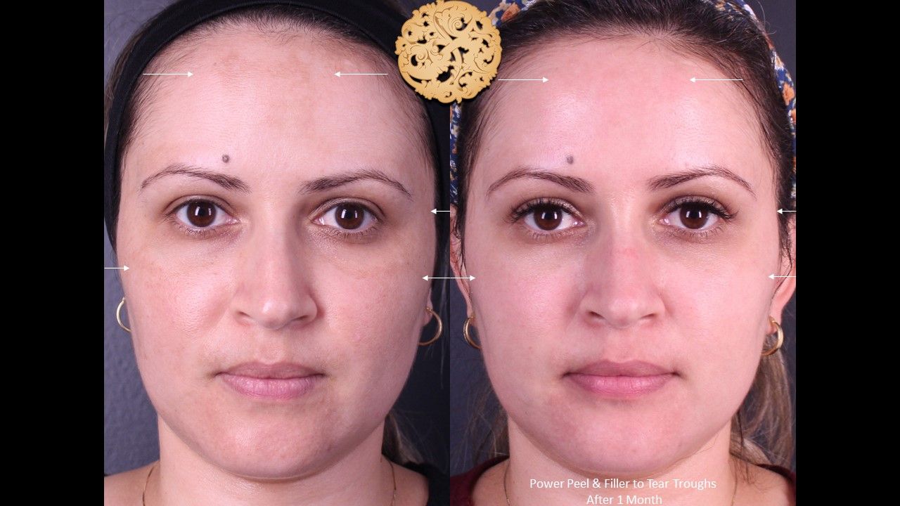 Botox Before & After