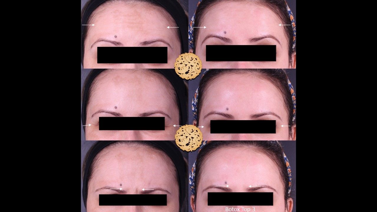 Botox Before & After