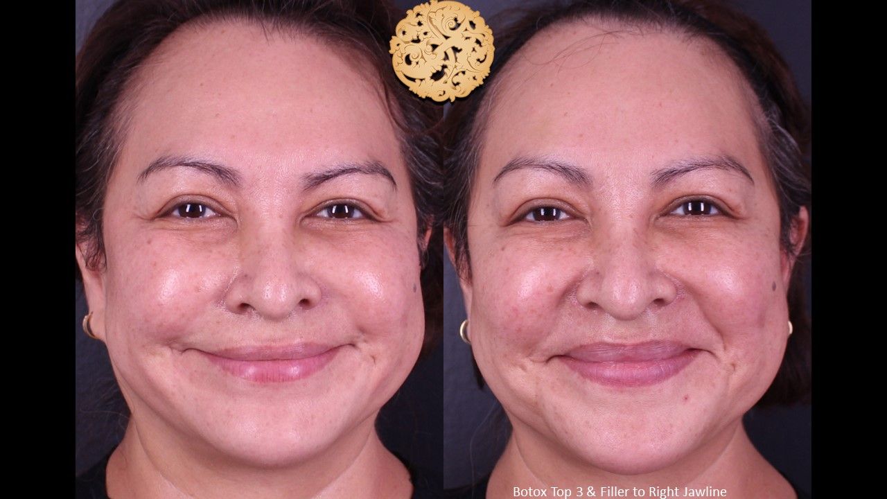 Botox Before & After