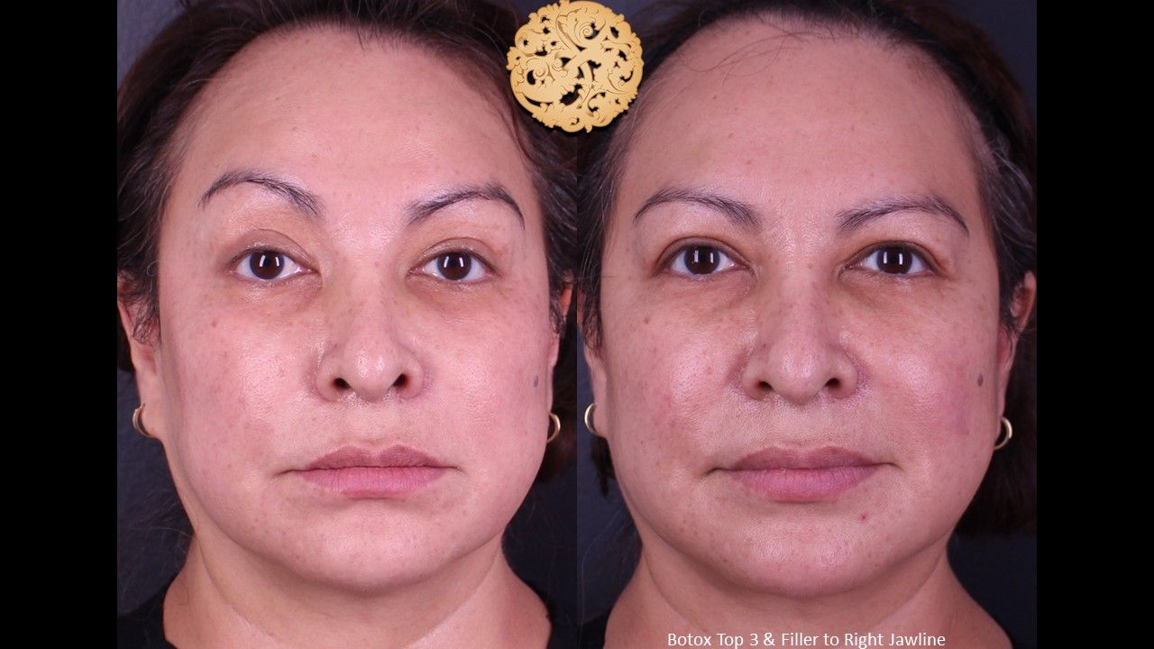Botox Before & After