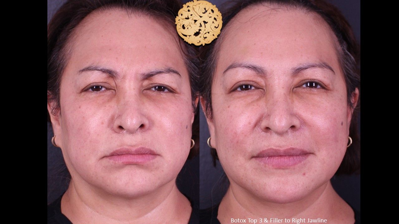 Botox Before & After