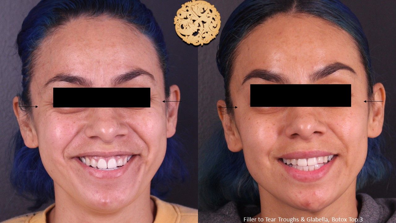 Botox Before & After