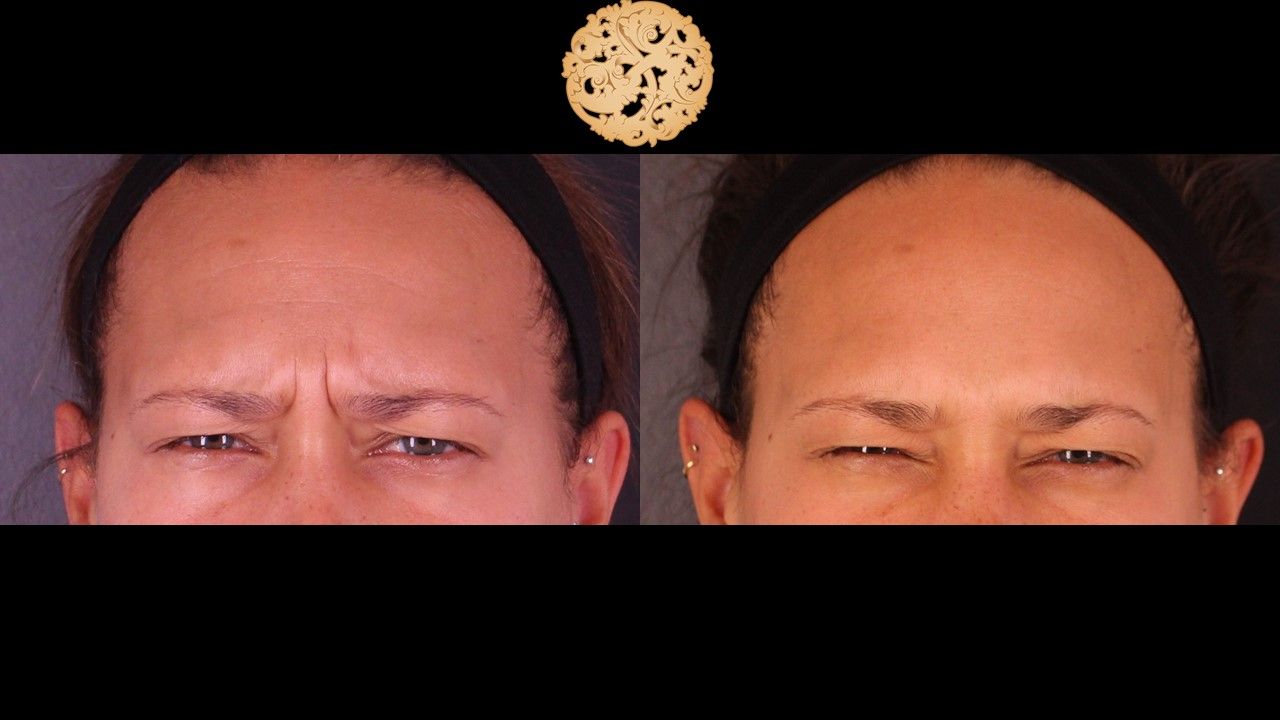 Botox Before & After