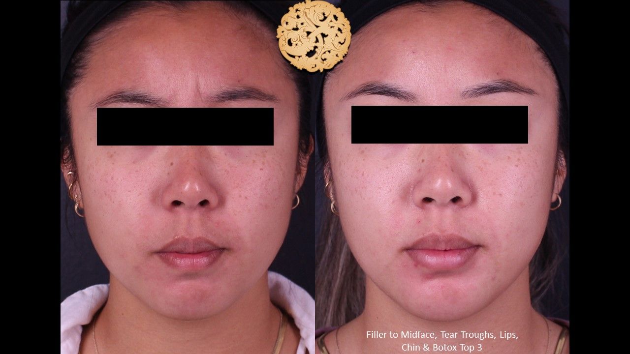 Botox Before & After