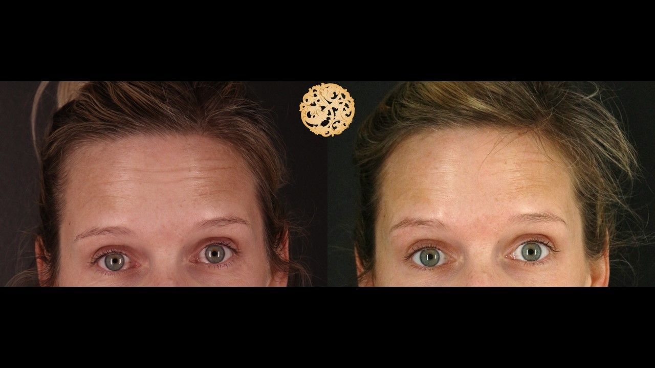 Botox Before & After