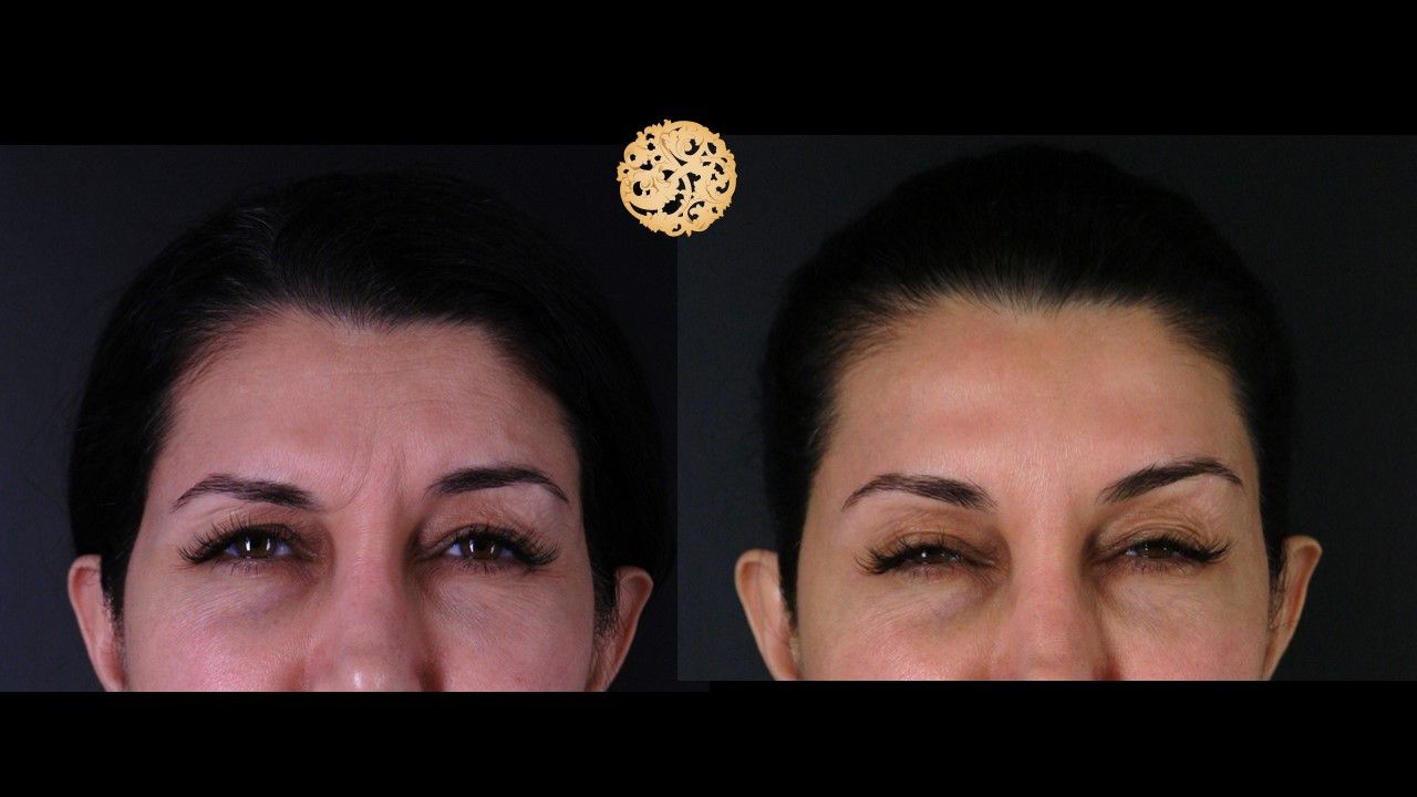 Botox Before & After