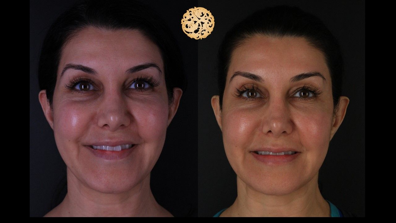 Botox Before & After