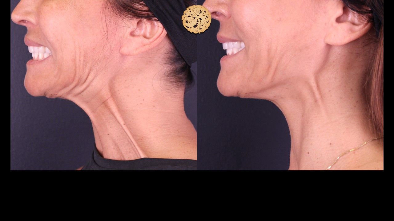 Botox Before & After