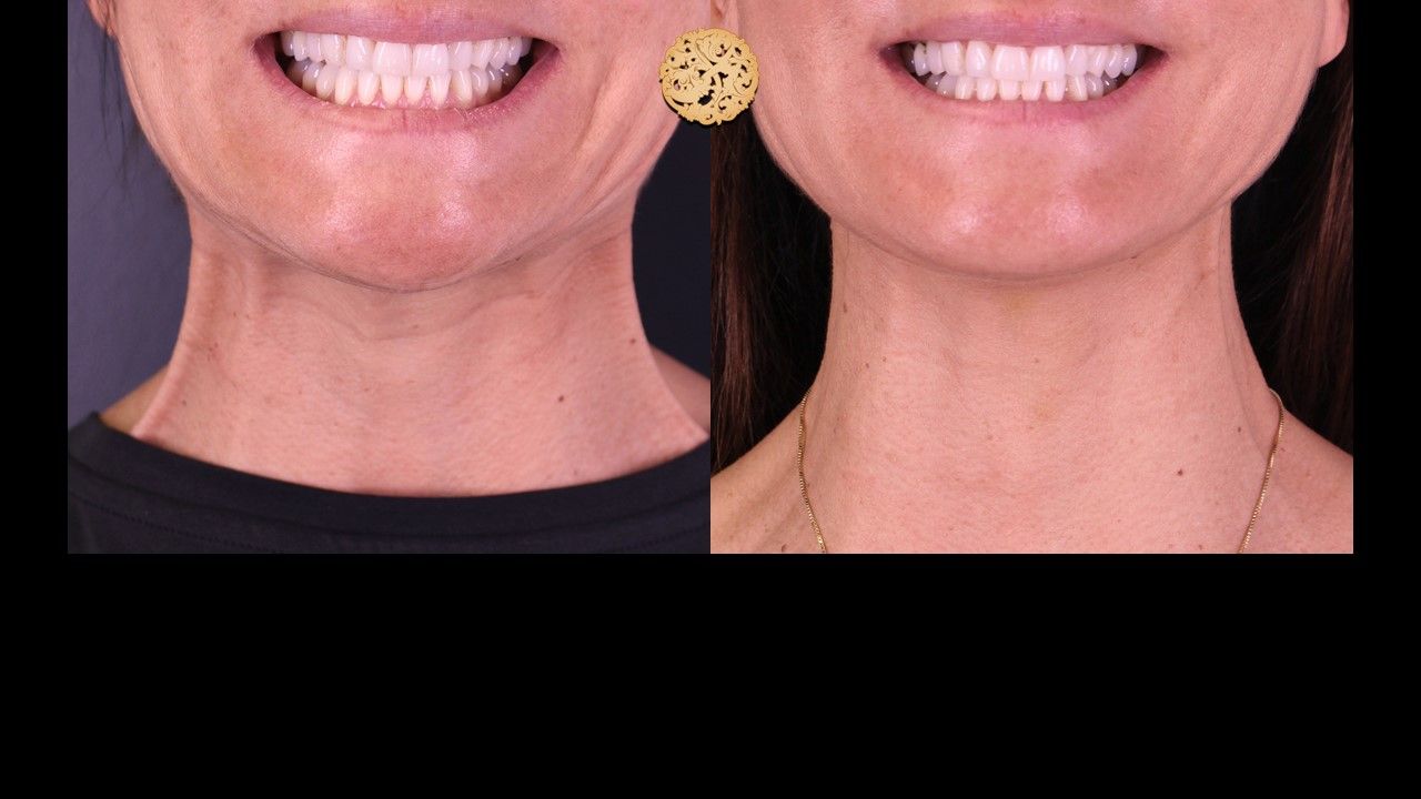 Botox Before & After