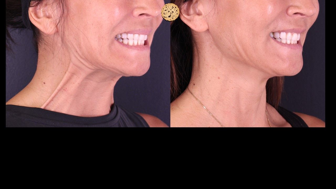 Botox Before & After