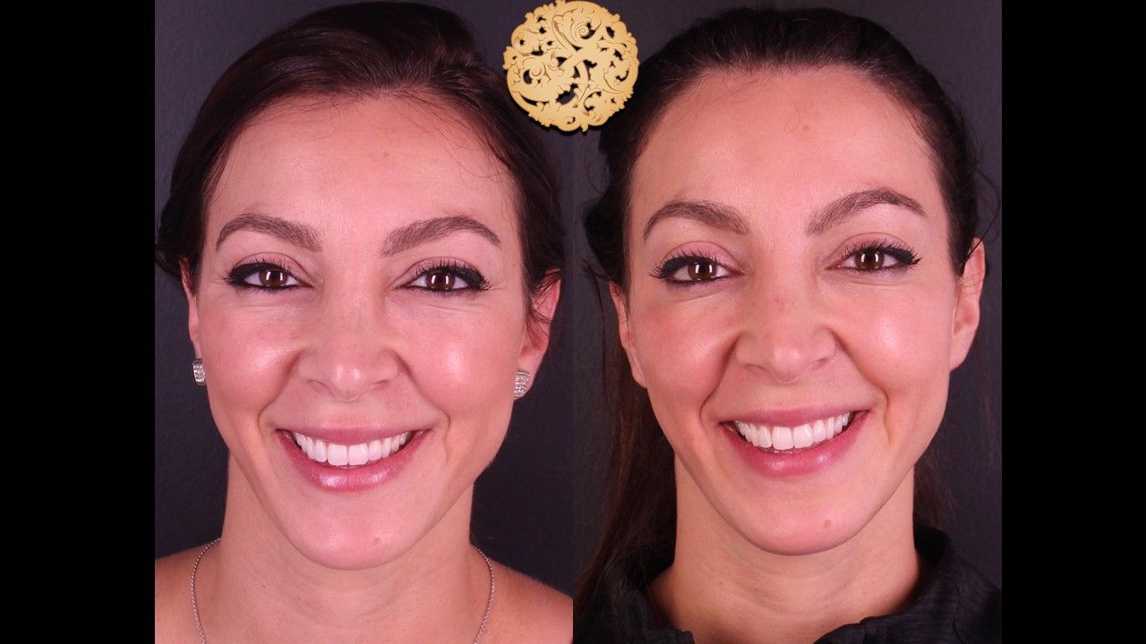 Botox Before & After