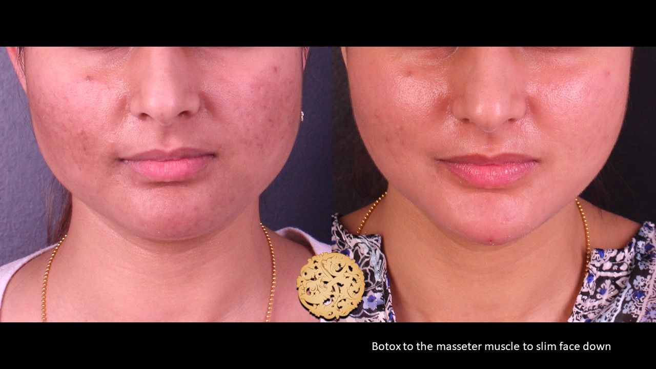 Botox Before & After