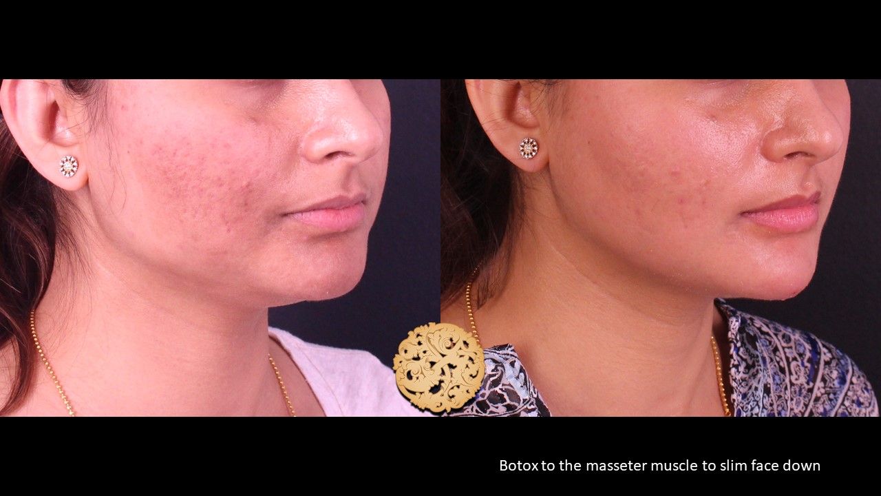 Botox Before & After