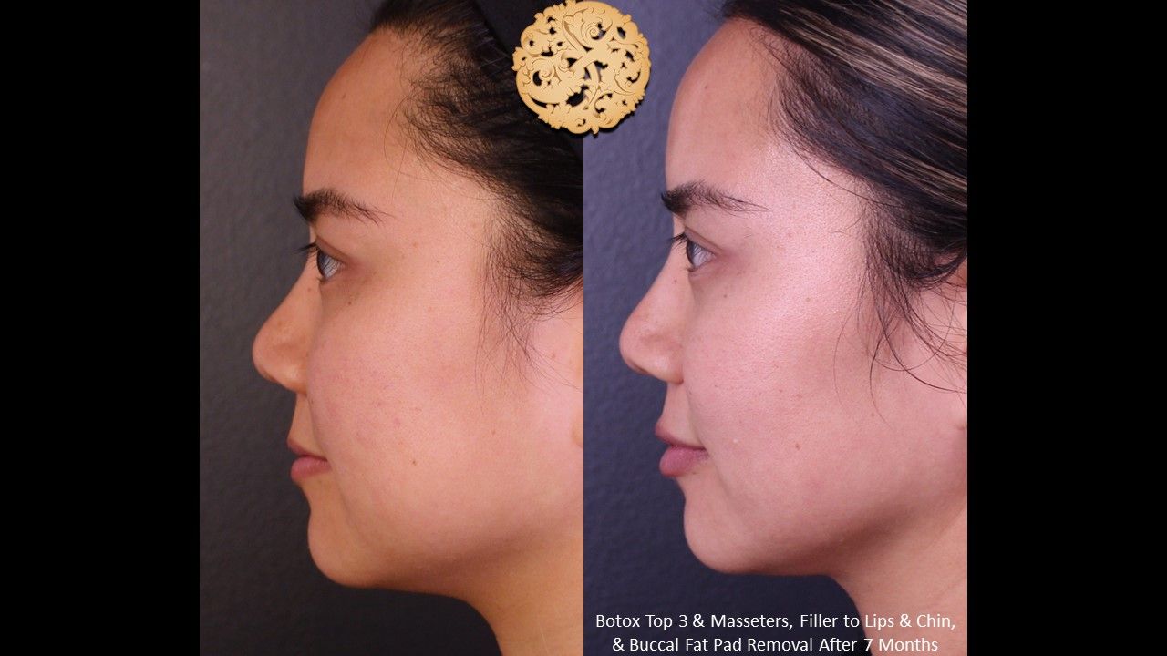 Botox Before & After