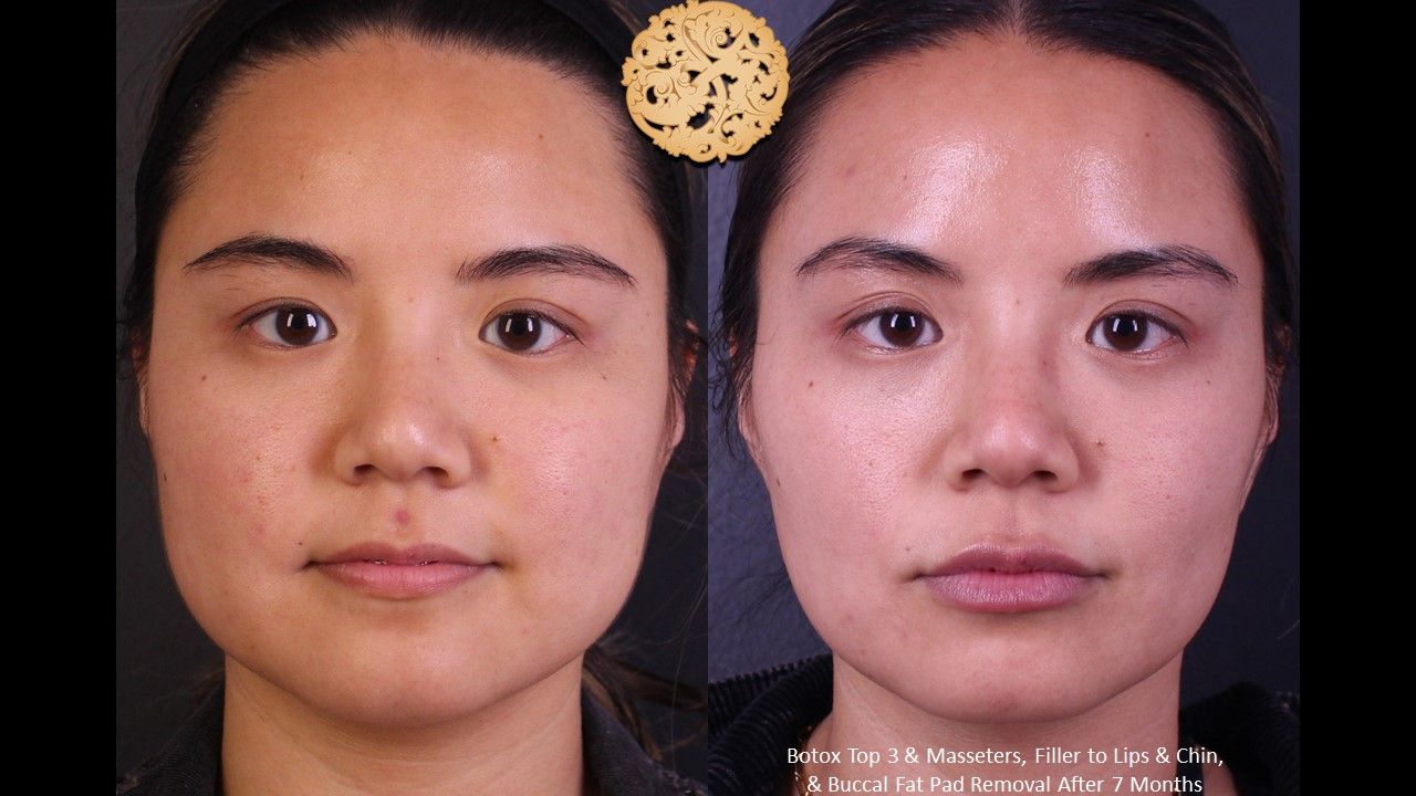 Botox Before & After