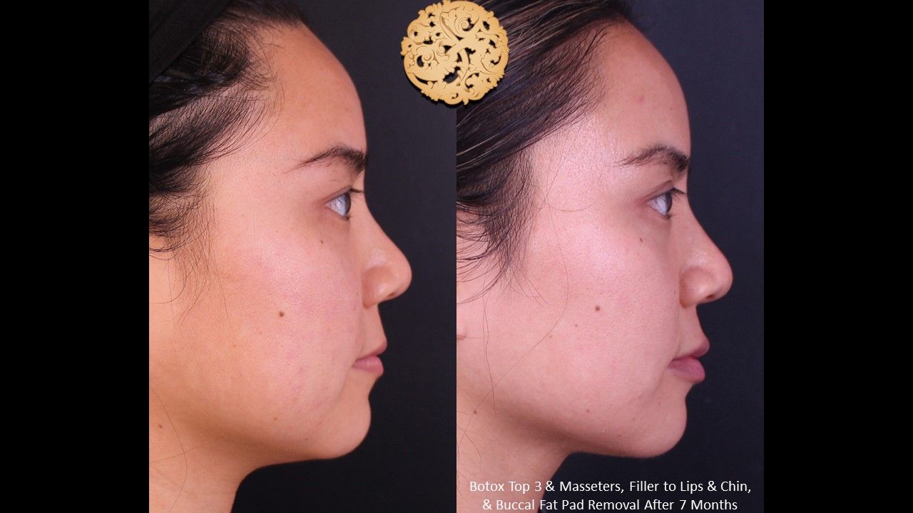 Botox Before & After