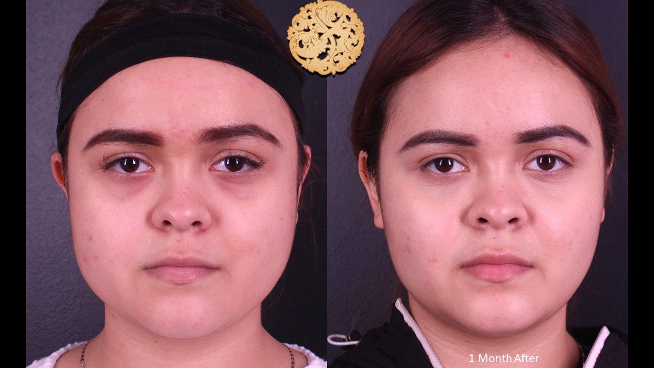 Botox Before & After