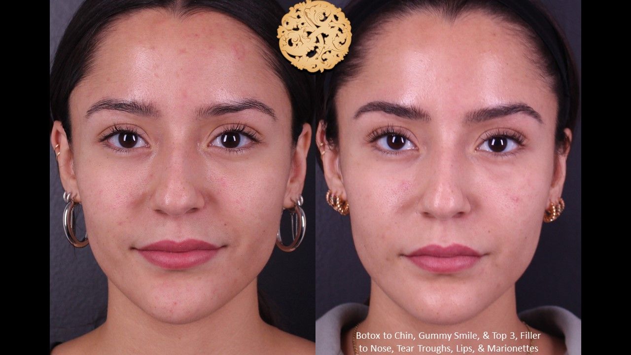 Botox Before & After