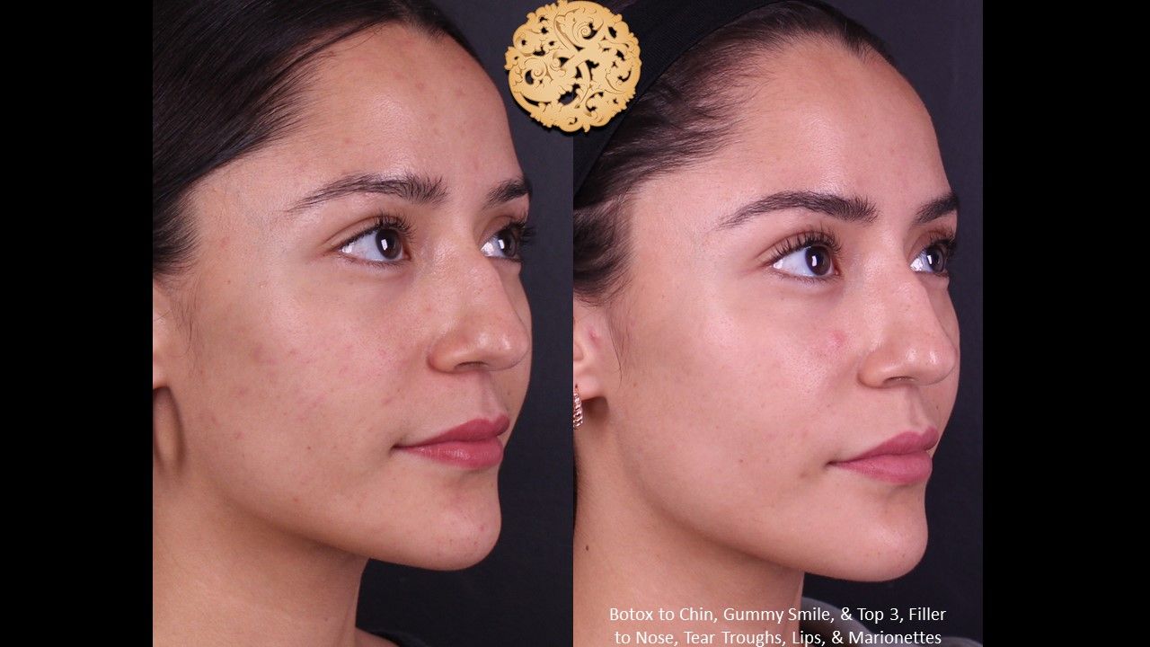 Botox Before & After