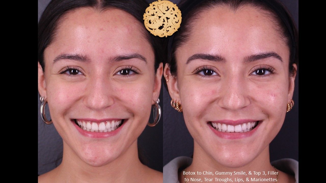 Botox Before & After