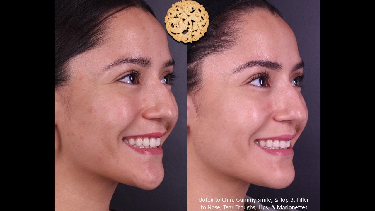 Botox Before & After