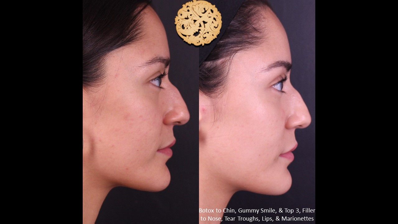 Botox Before & After