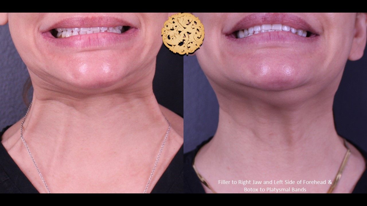 Botox Before & After